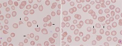 Case Report: A Rare Case of Thrombotic Microangiopathy Induced by Remethylation Disorders